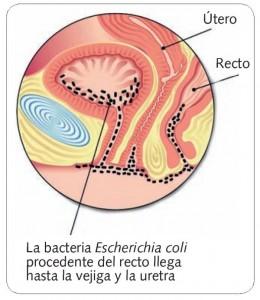 Cistitis